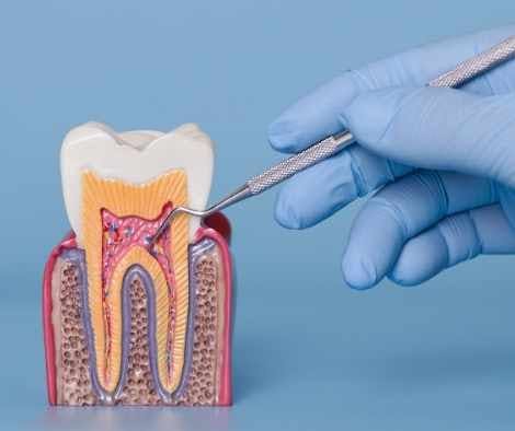 Diagram or close up of swollen gums and dental abscess